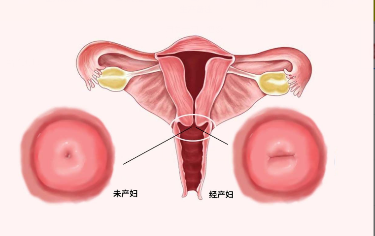 经产妇和初产妇宫颈口区别图片