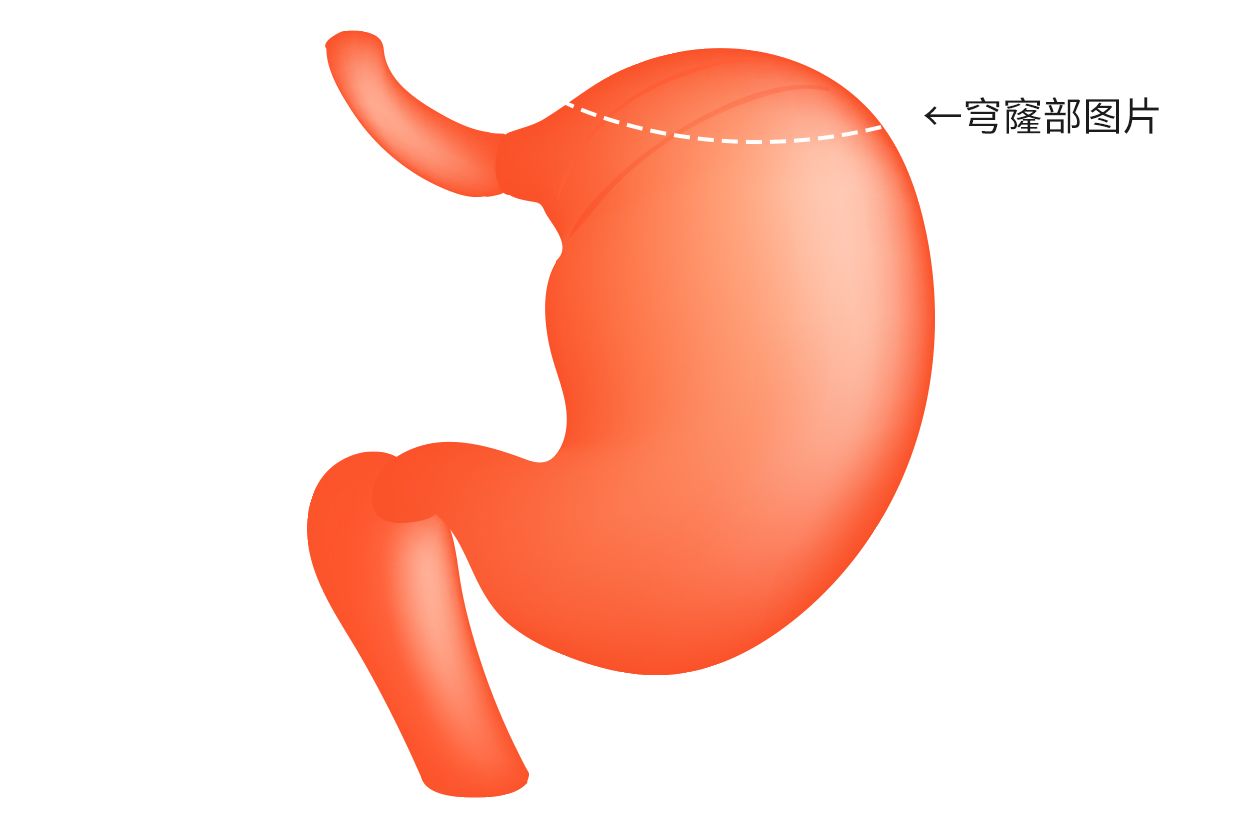 胃底穹窿部图片 胃底穹窿处隆起有可能是什么