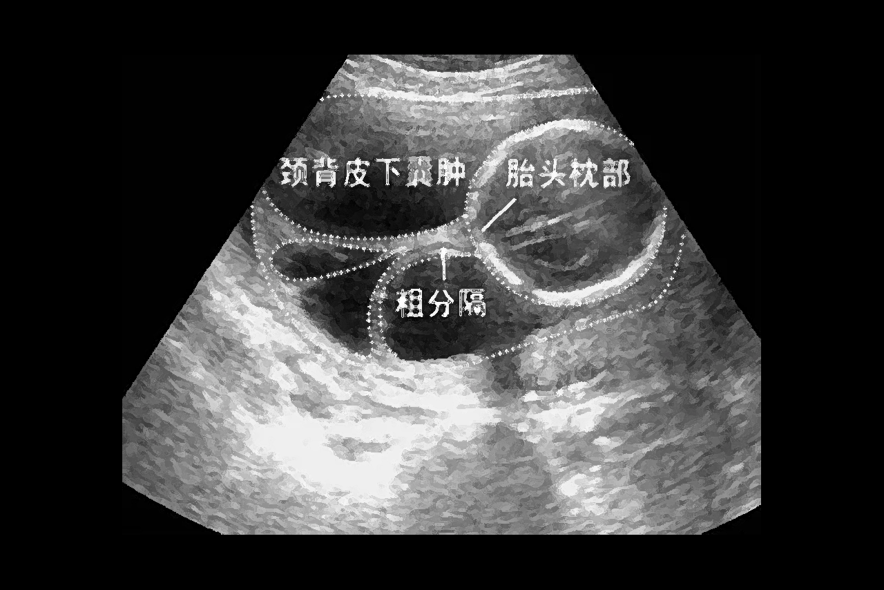 四个月胎儿颈部水囊瘤图片（婴儿颈部水囊瘤图片）