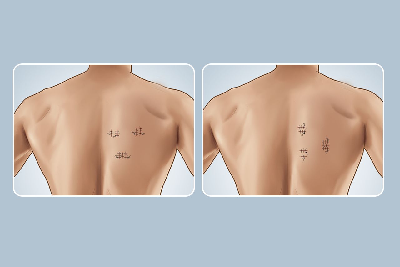 背部手术切口方向图片（背侧切开手术图解）