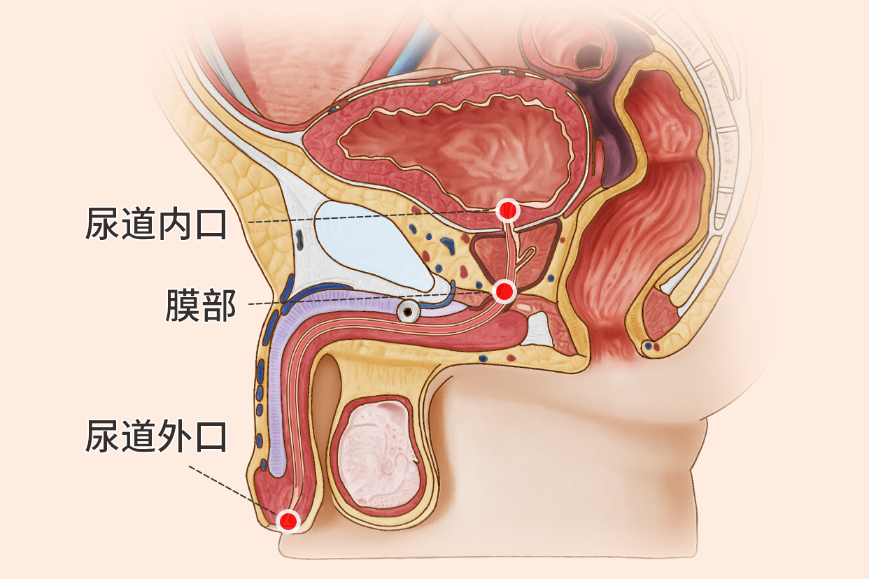尿道狭窄图片 尿道狭窄部位图