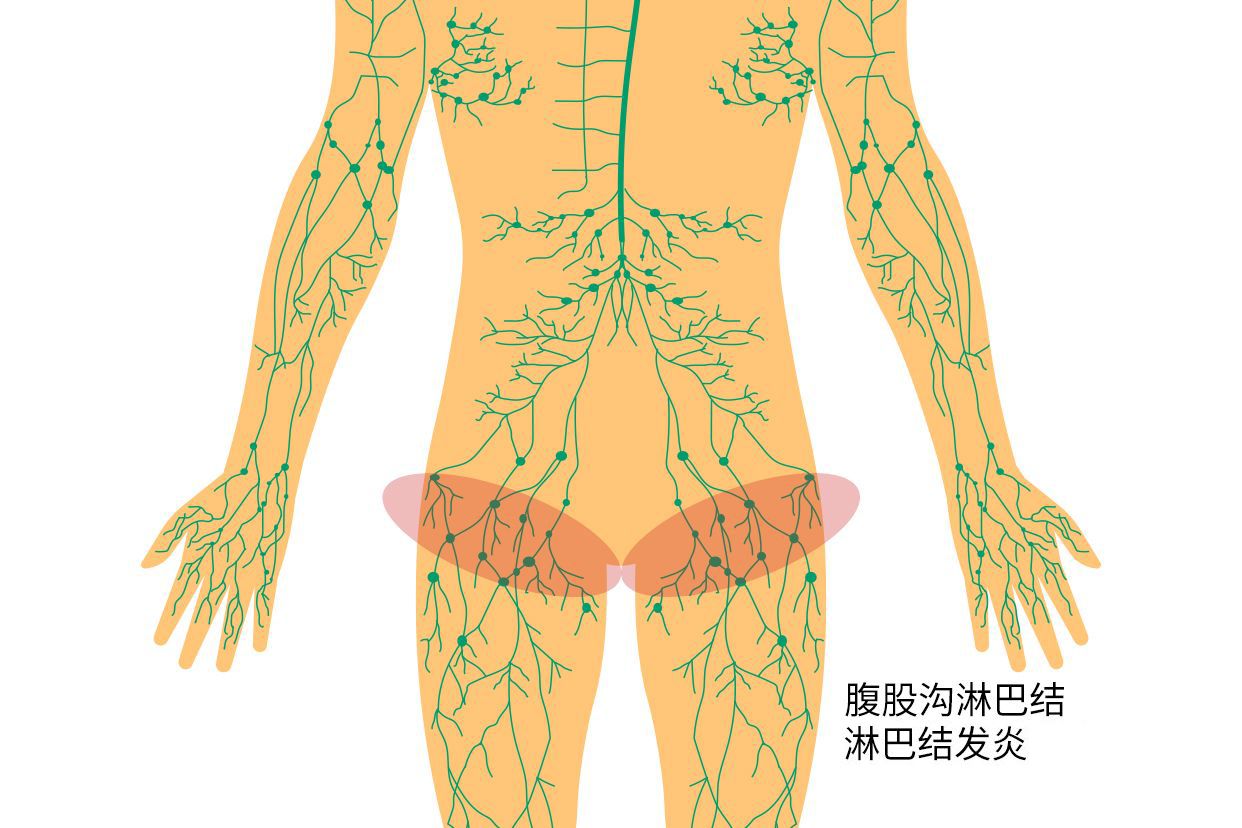 胯骨淋巴结发炎示意图（胯部淋巴结发炎）