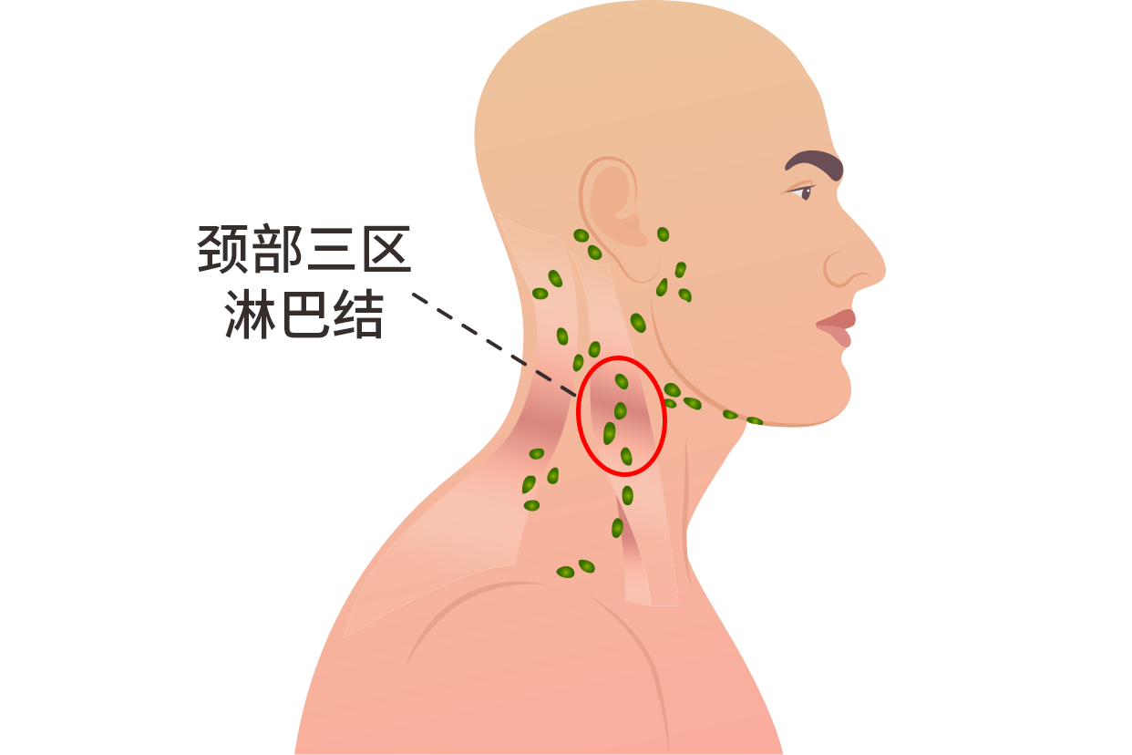 颈部三区淋巴结位置图（颈部淋巴三区哪个位置）