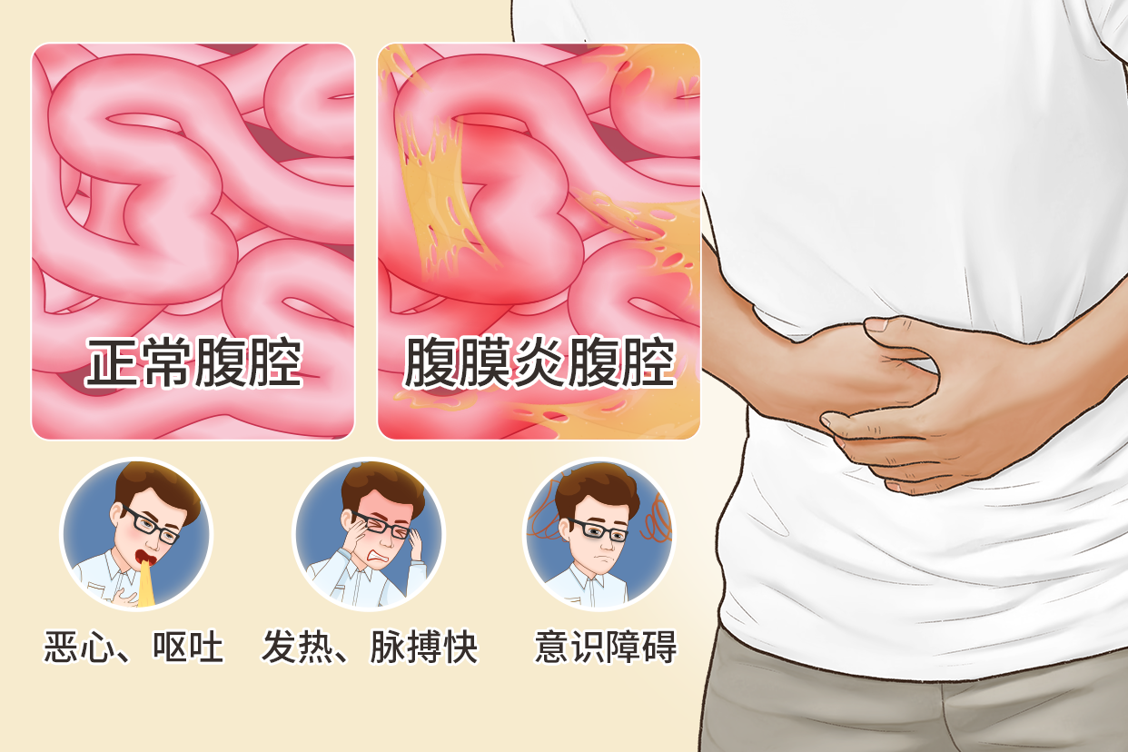 腹膜炎图片（急性腹膜炎图片）