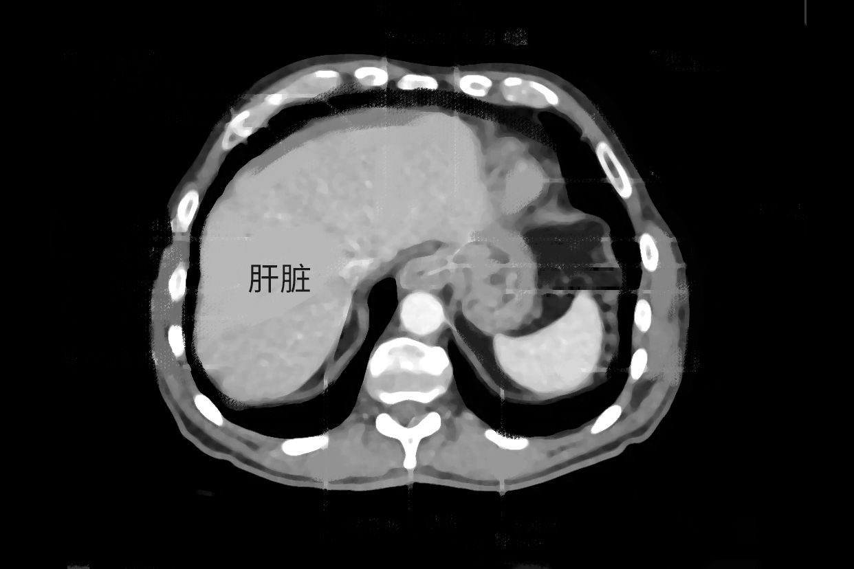上腹部ct解剖图（腹部ct解剖图详细图）