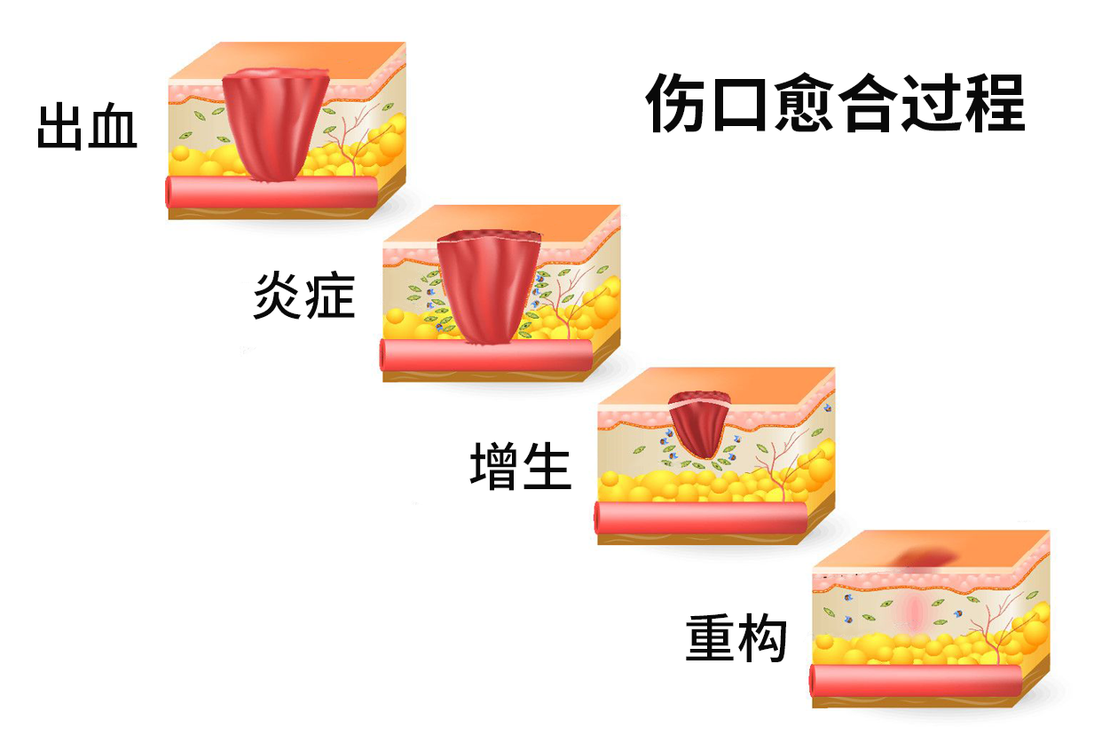 伤口愈合扇形图