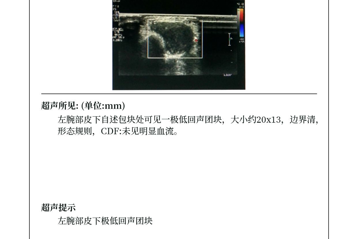 囊肿检查报告图片