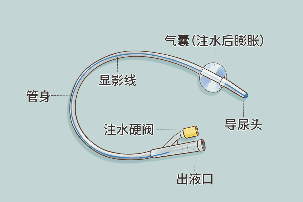 膀胱造瘘引流导尿管的图片