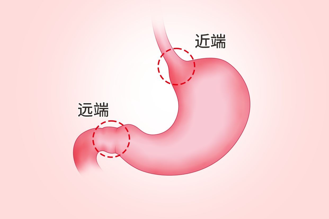 胃远端与近端的区别图 胃远端与近端的区别图片