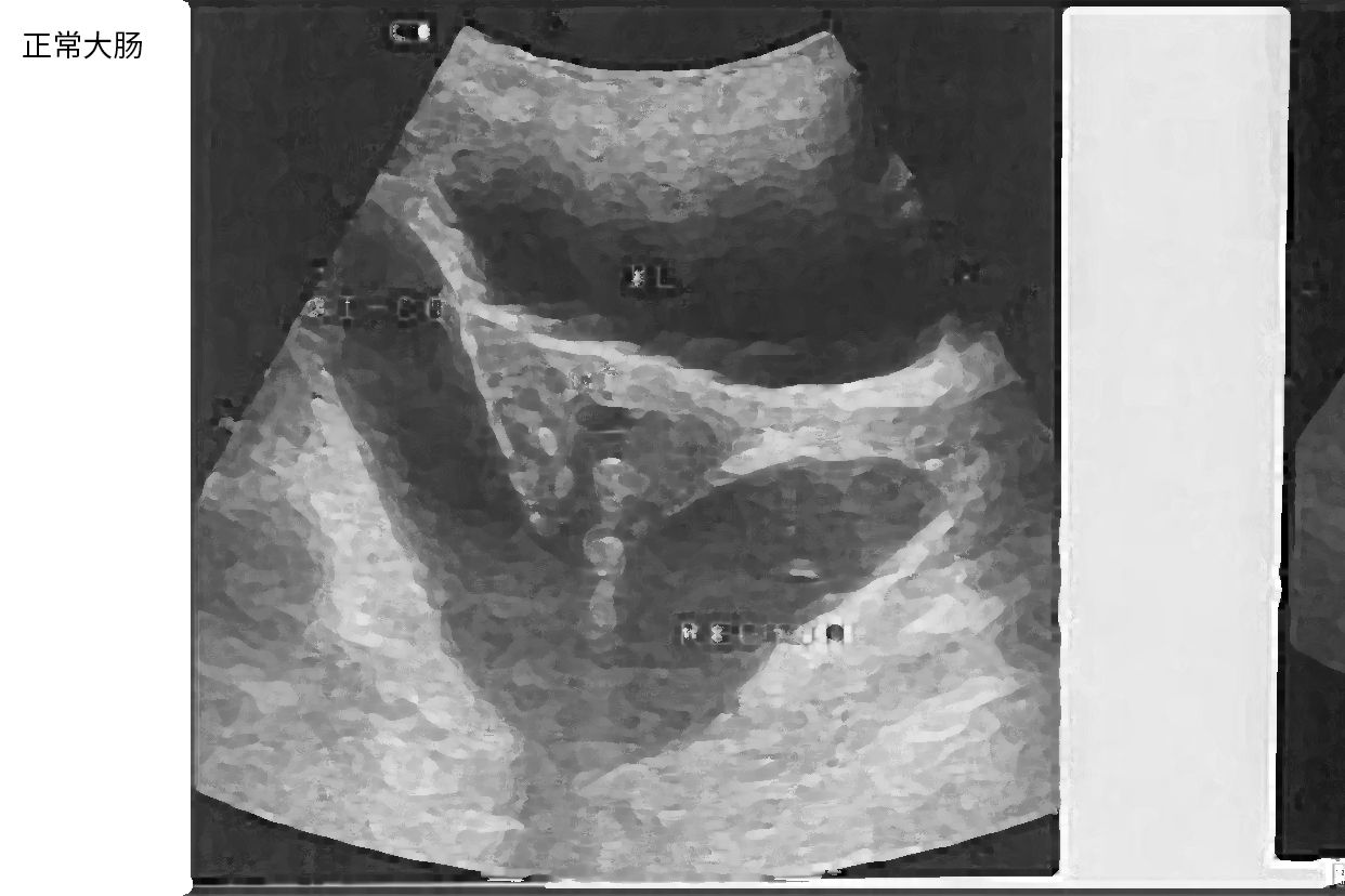大肠和小肠的超声图像 肠管超声图像