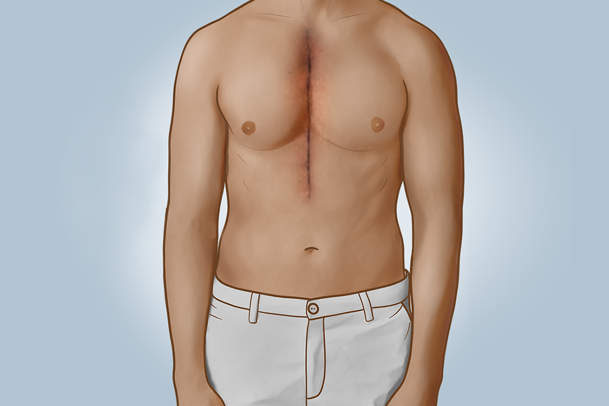 开胸手术拆线后伤口图片 开胸术后伤口多久拆线