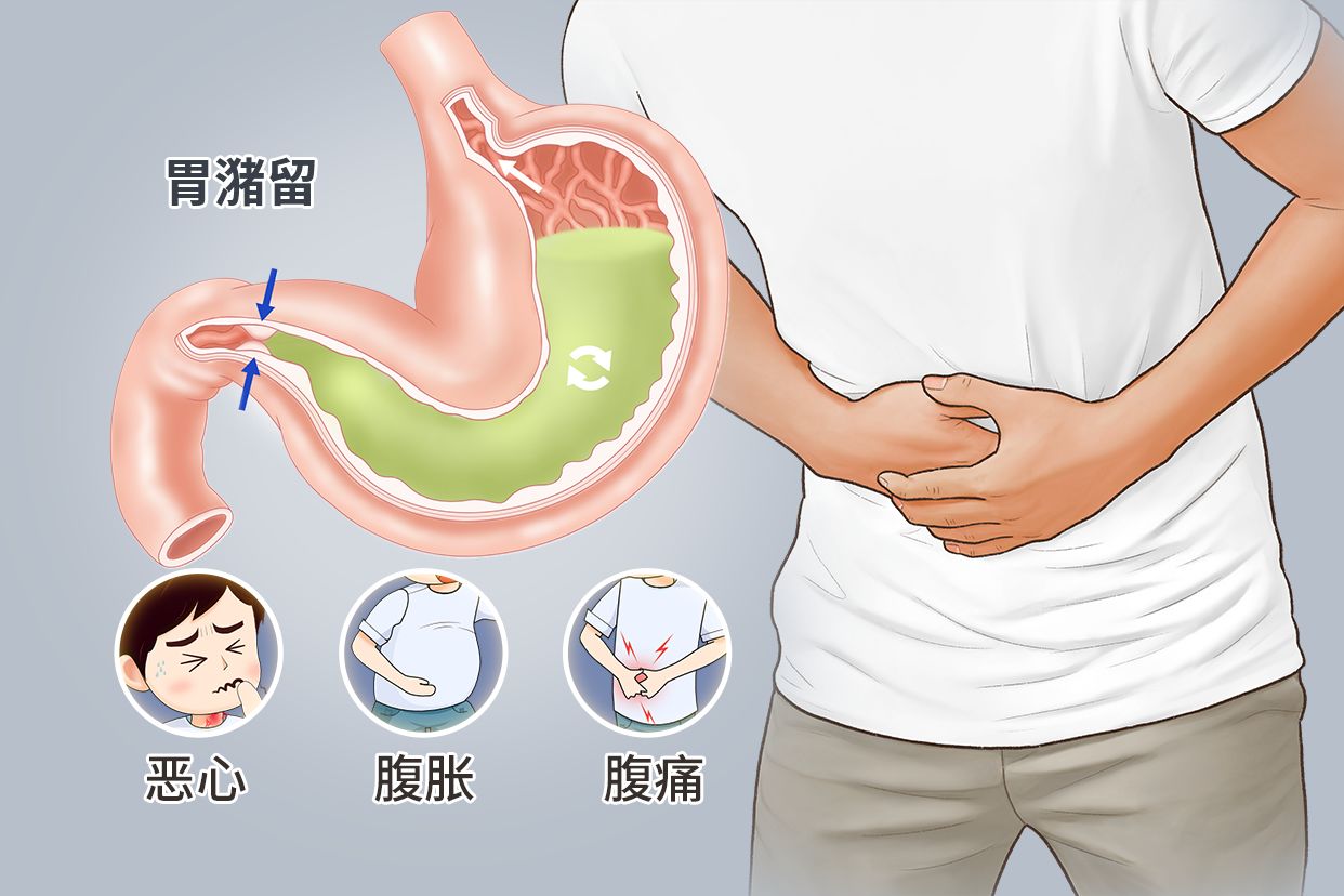 胃潴留图片（胃潴留胃潴留）
