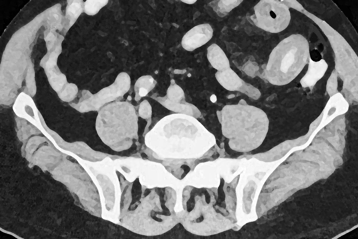 升结肠炎ct图解 结肠炎CT图片
