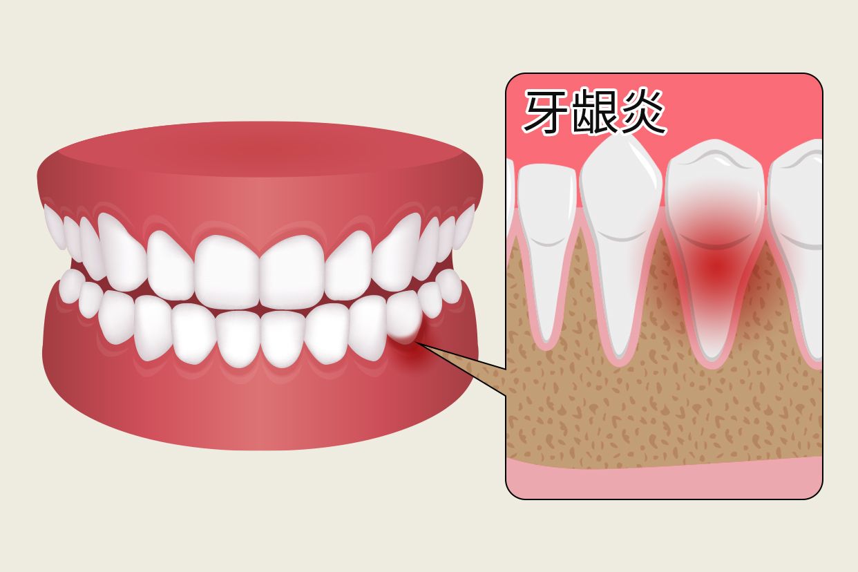 牙龈炎早期症状图片（牙龈炎图片）
