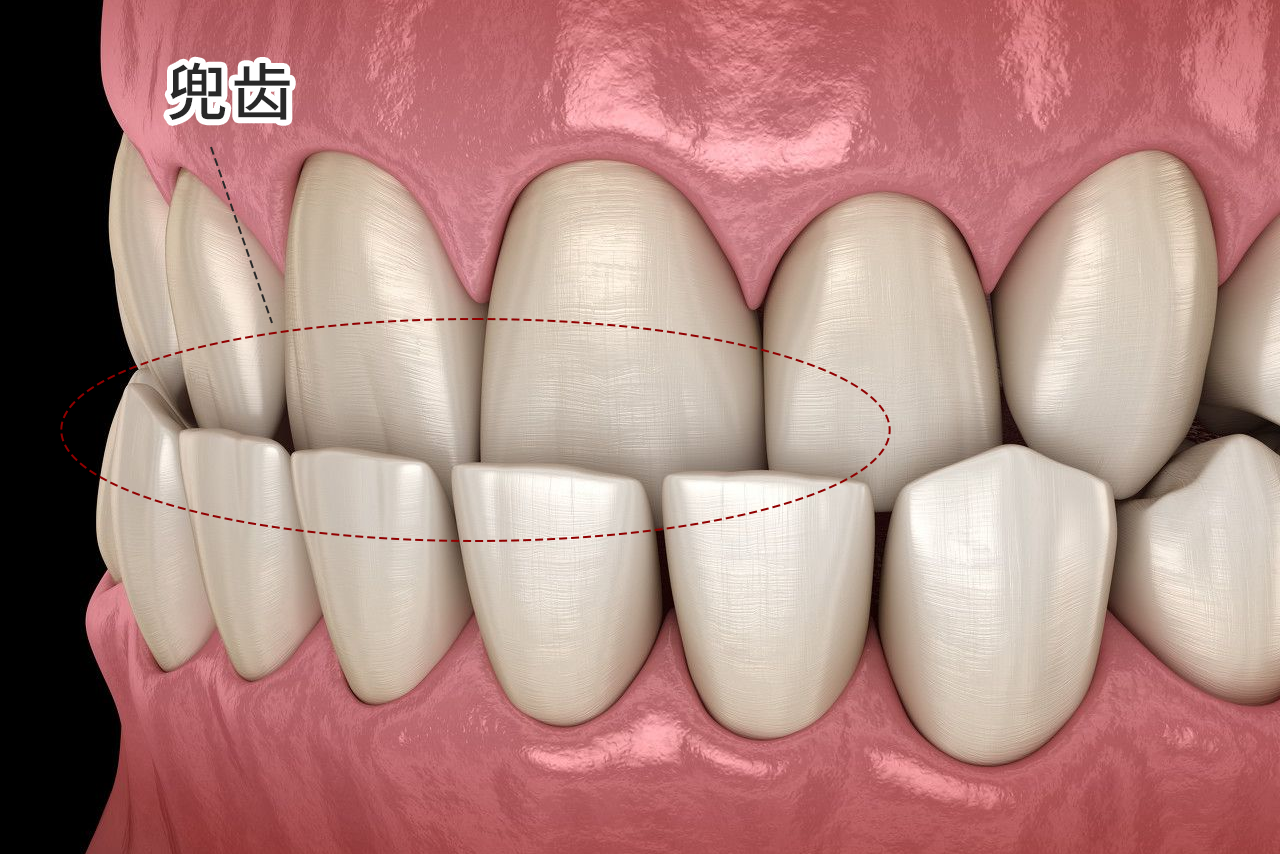 轻微兜齿图片（兜齿 图片）