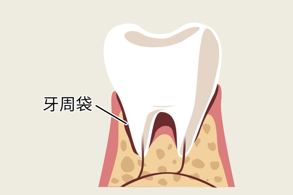 什么是牙周袋及图片 门牙牙周袋图片