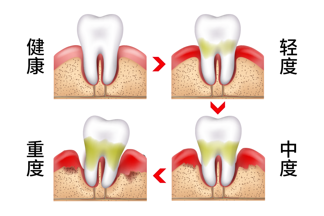 牙周轻中重度前后图片（重中度牙周炎矫正前后）