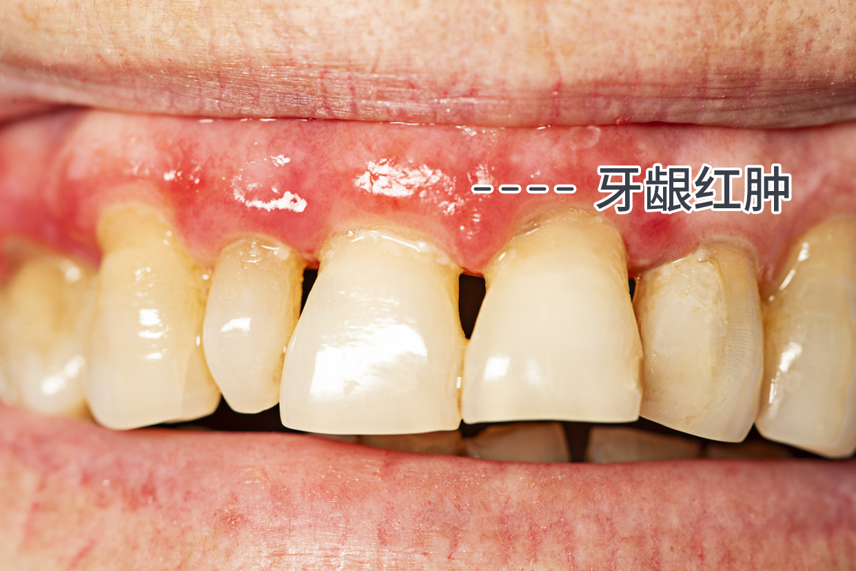 牙周炎牙龈红肿的图片 牙周炎牙龈红肿的图片和症状