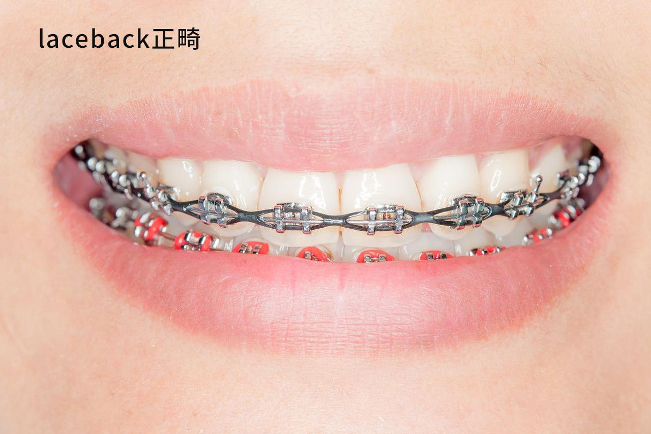 laceback正畸示范图 正畸laceback的作用