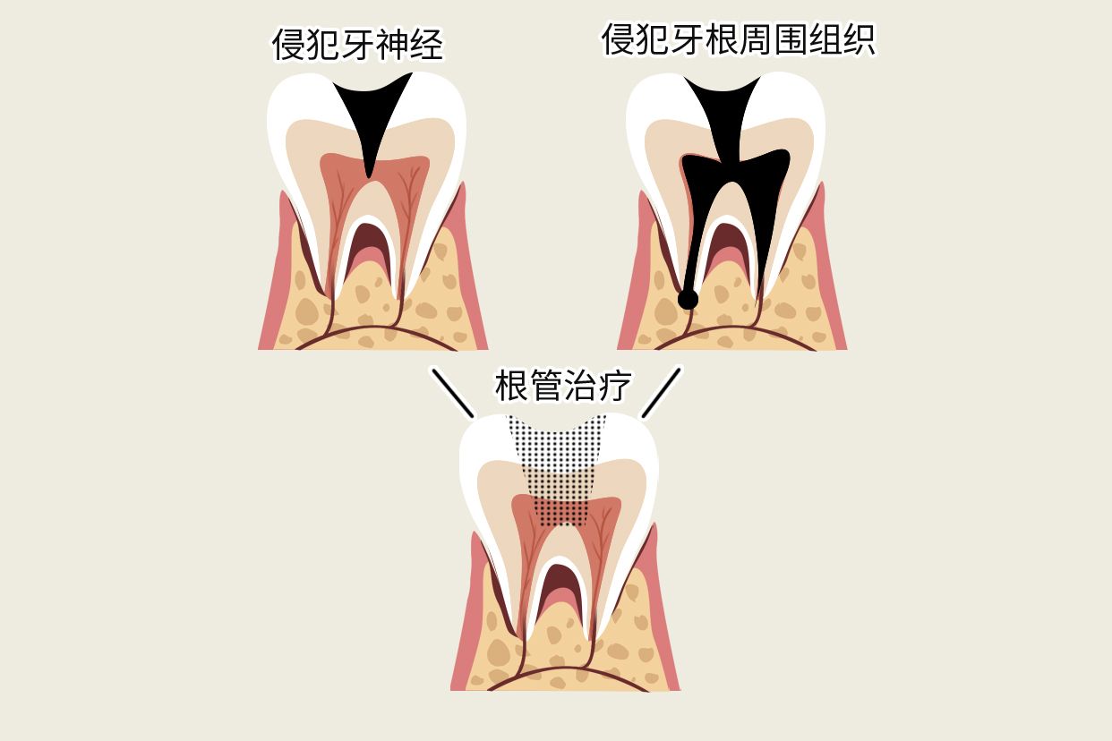 牙烂到什么程度要根管治疗图片 牙齿烂成什么样需要根管