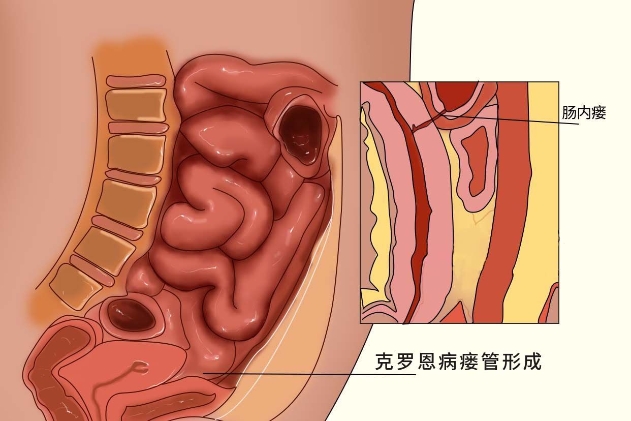 克罗恩病瘘管形成图片 克罗恩瘘管形成怎么办