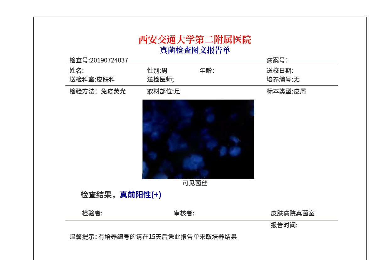 真菌检查报告单图片 真菌检查报告单图片怎么看