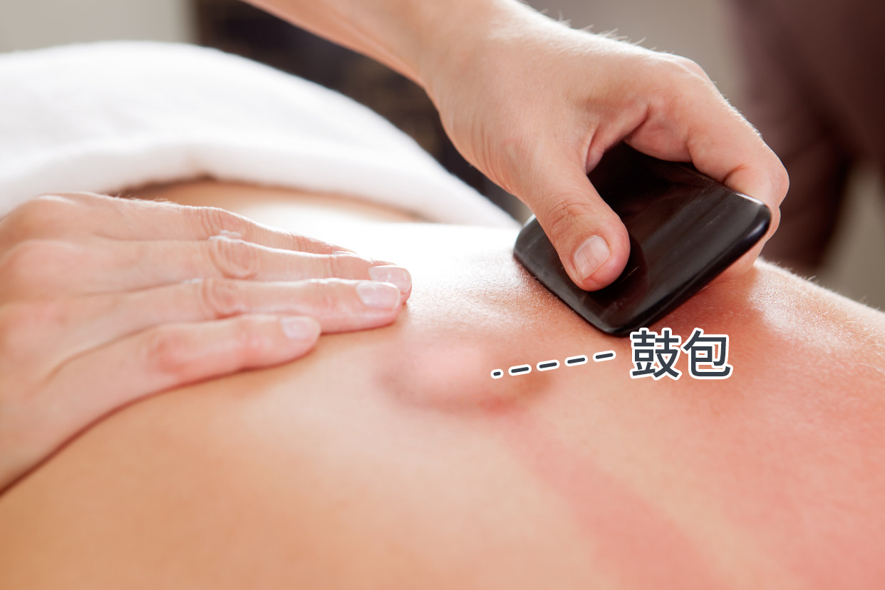 刮痧后鼓包图（刮痧刮出来毒疙瘩图片）