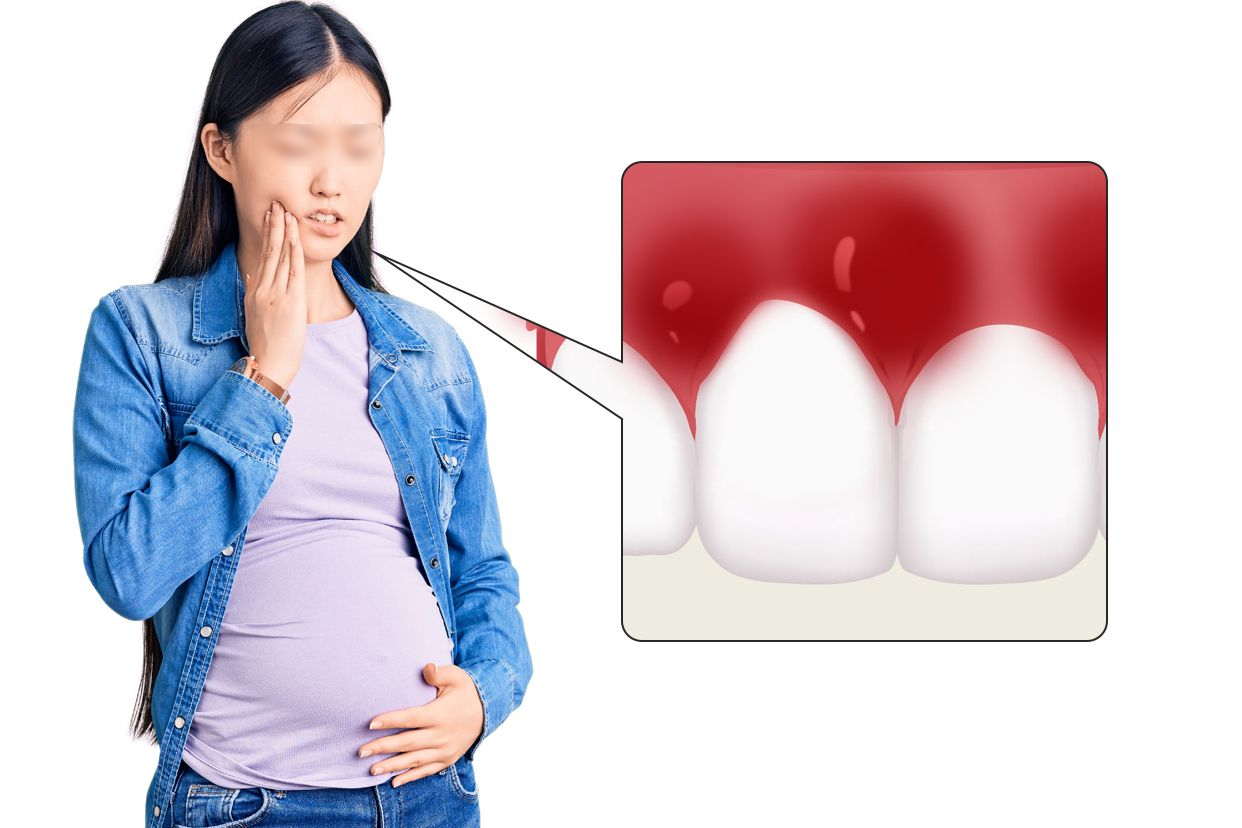 妊娠期牙龈炎图片（孕妇牙龈发炎怎么消炎最快）