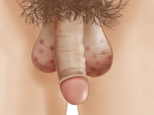 男人生殖器上长红点的图片 男性生殖上有红点