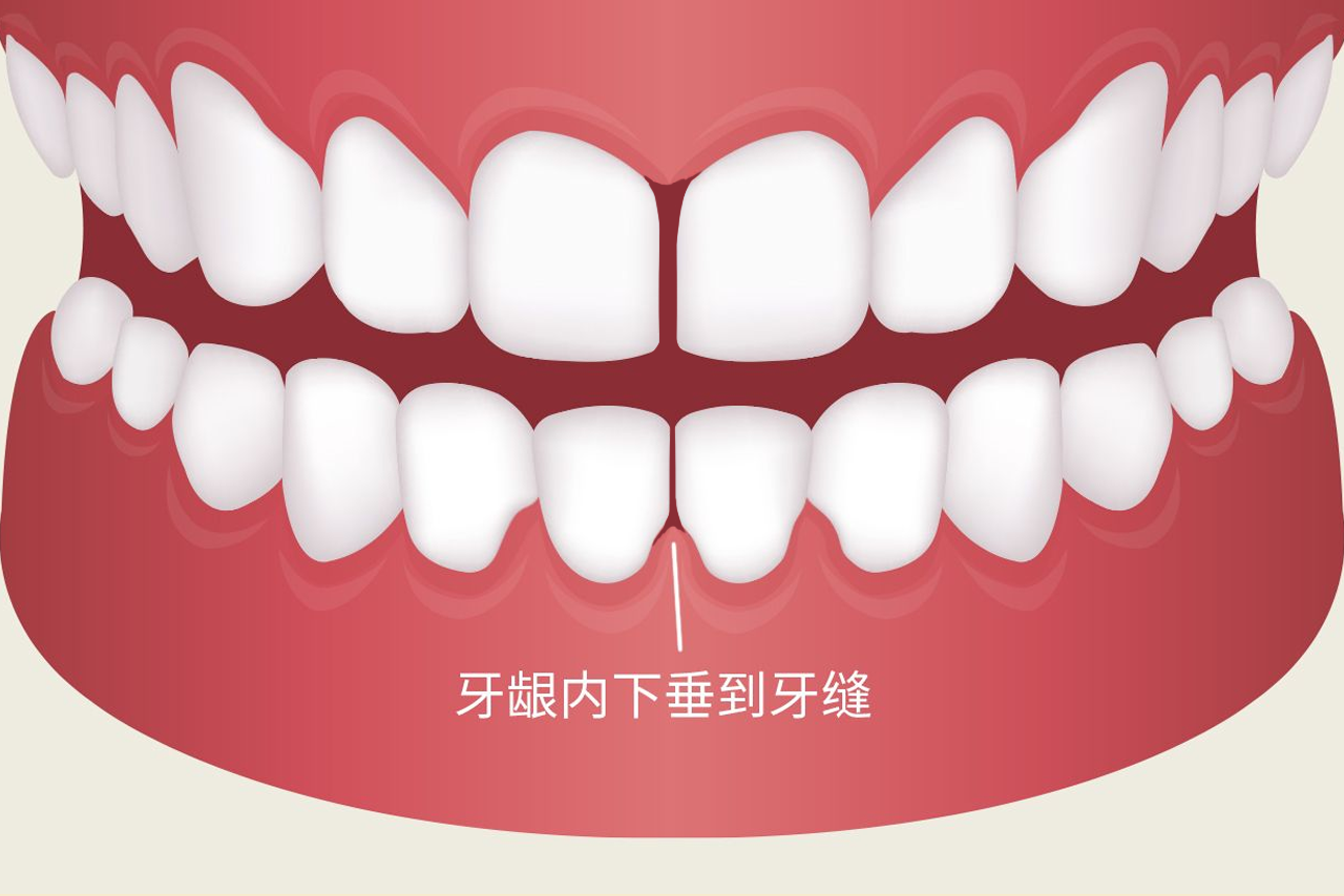牙龈内下垂到牙缝是什么引起的图片（牙龈垂下来是怎么回事）
