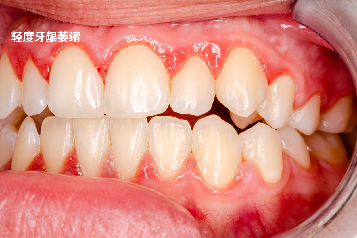 轻度牙龈萎缩图片初期 重度牙龈萎缩图片