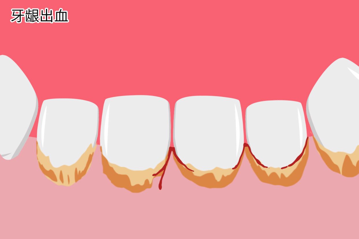 牙结石会导致牙龈出血吗图片 有牙结石牙龈会出血吗
