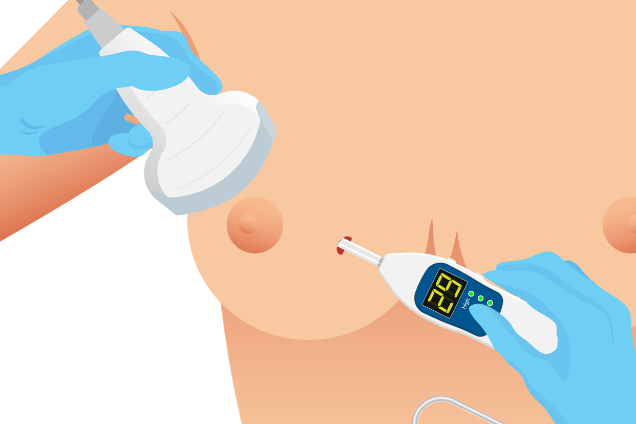 乳房微创手术图片（乳房微创手术伤口图片）