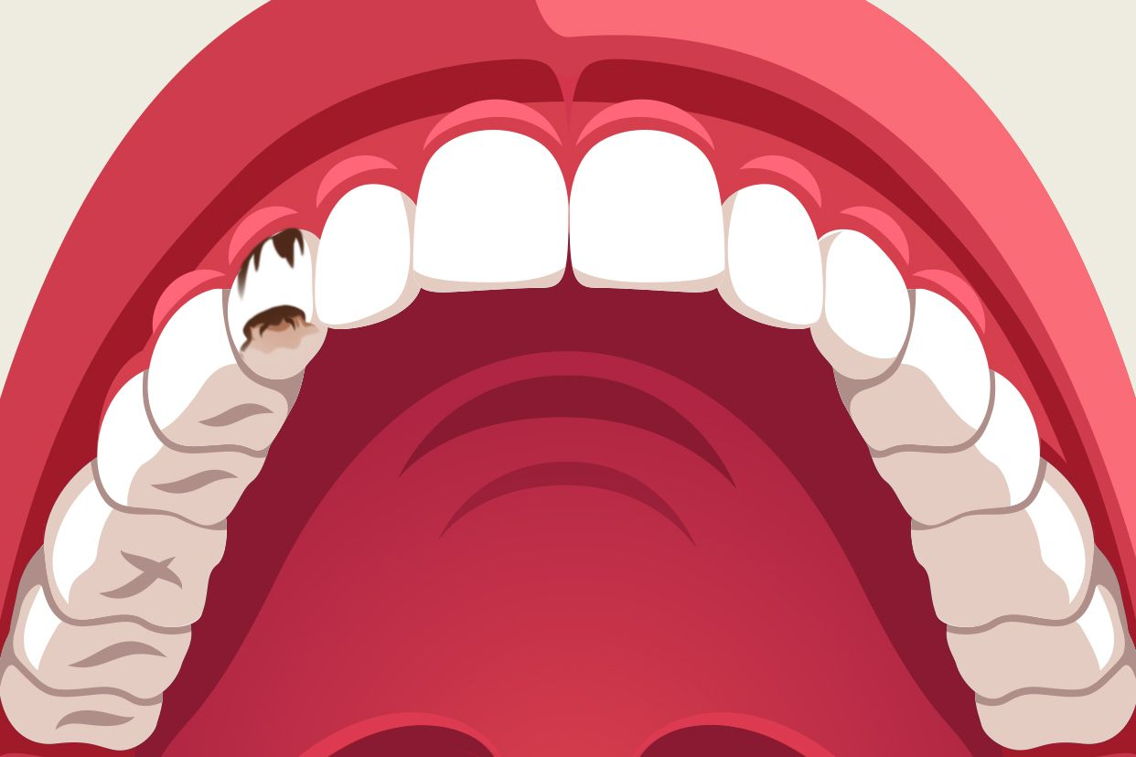 尖牙蛀牙图片 尖牙龋齿图片