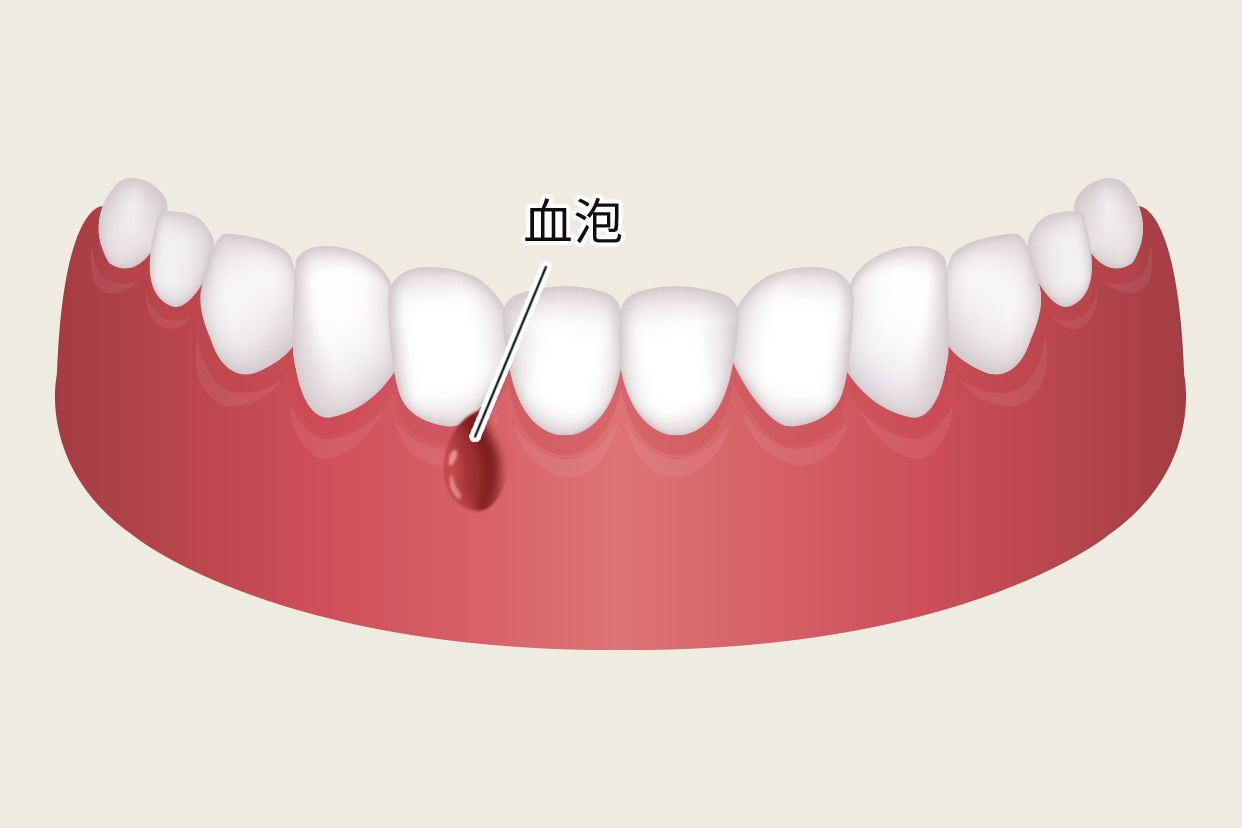 牙床长了血泡怎么办图片（牙床长了血泡怎么办图片）