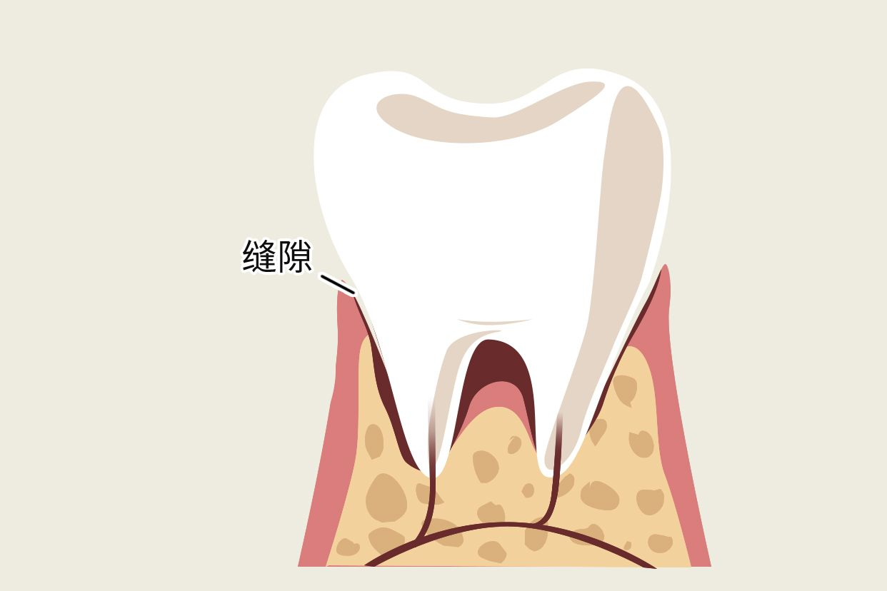 牙冠和牙龈有缝隙图 牙冠和牙龈有缝隙图片