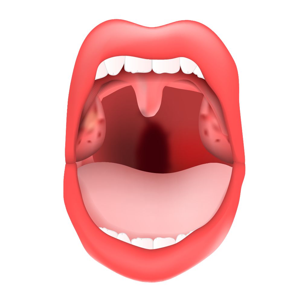 舌弓发炎图片（舌鄂弓发炎）