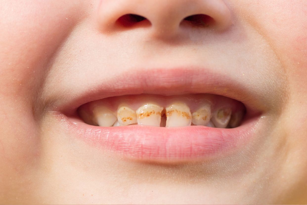 门牙龋齿严重程度分型图片（门牙中度龋齿图片）