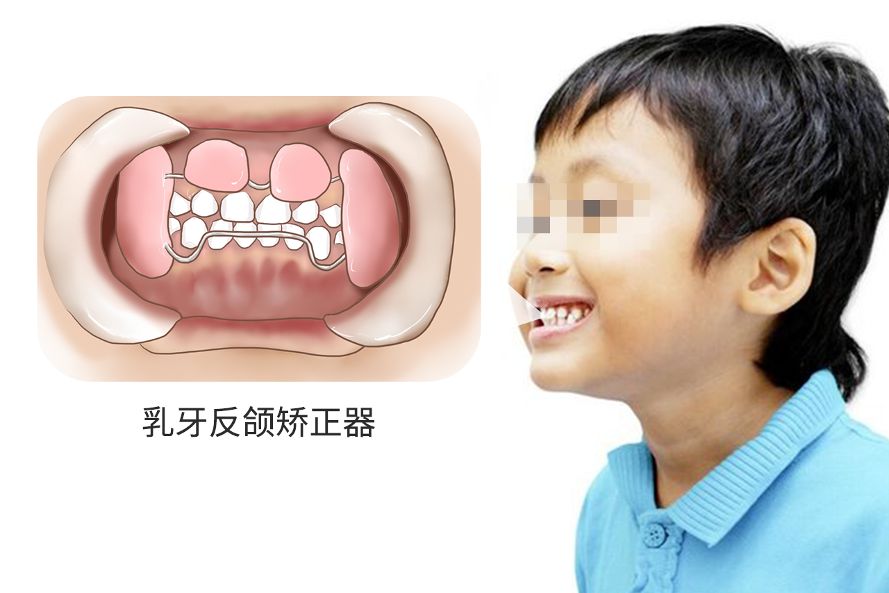 乳牙反颌矫正器图片（乳牙单侧后牙反颌矫治器图片）