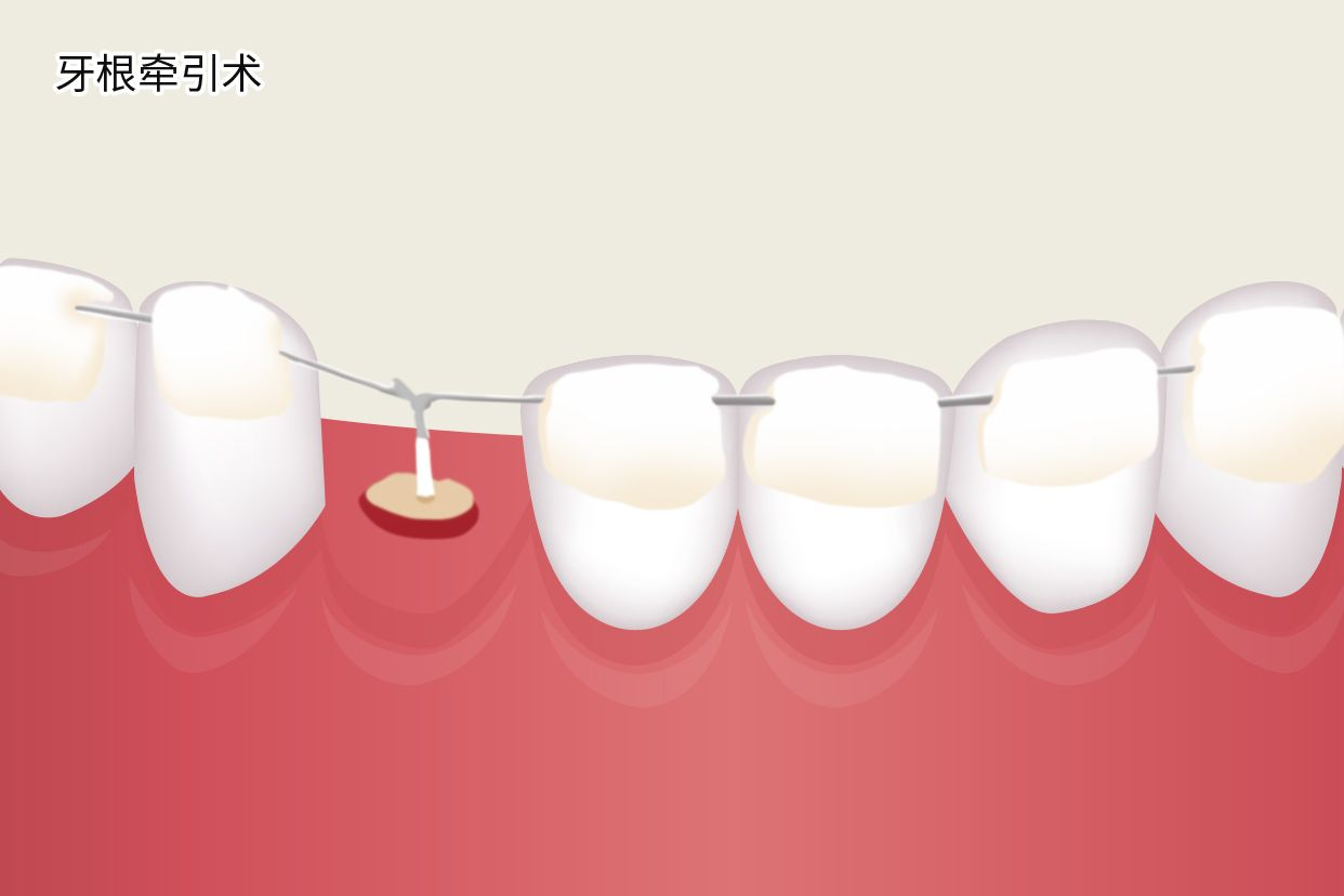 牙根牵引术图解（牙牵引手术图）