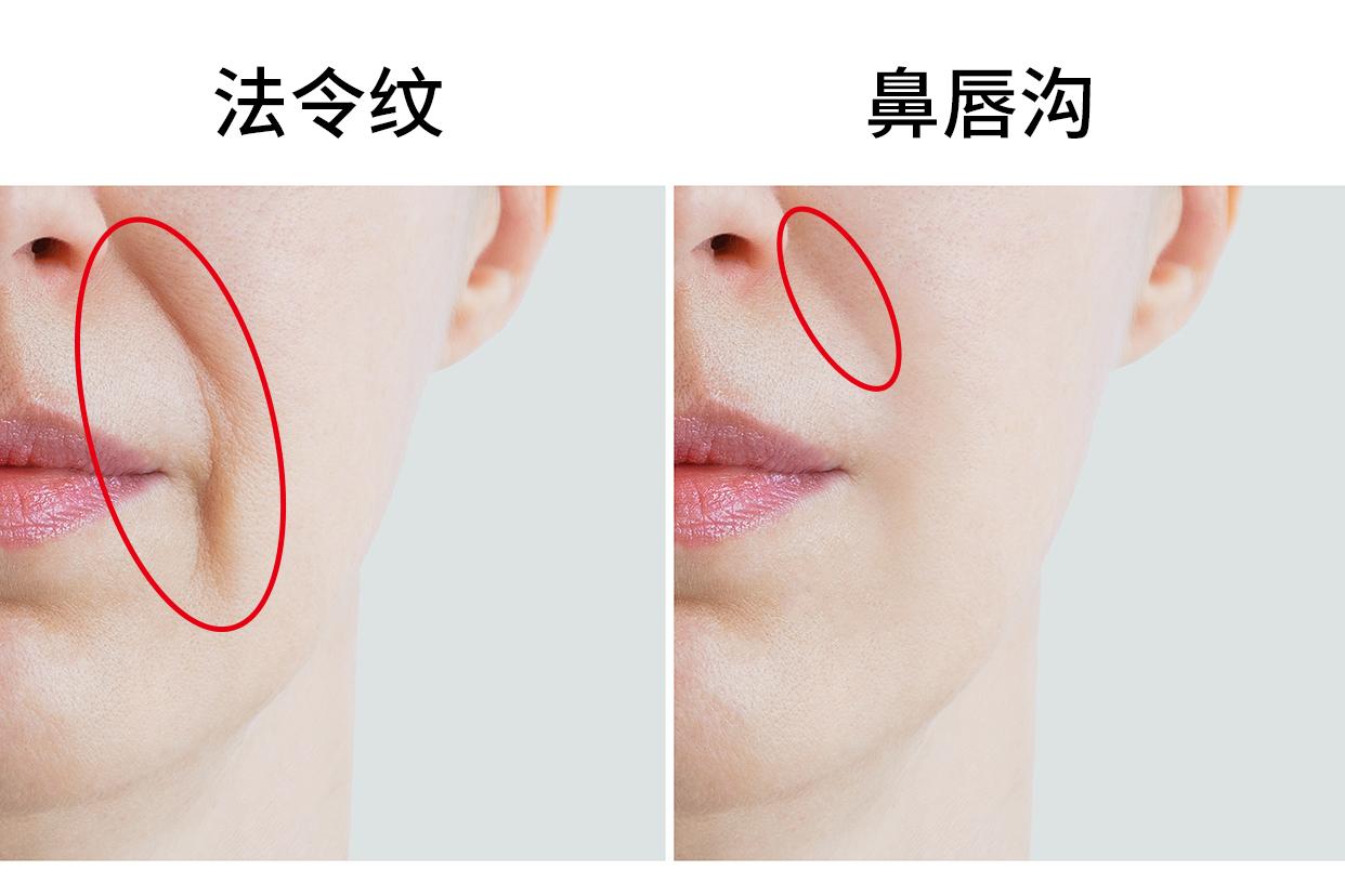法令纹和鼻唇沟的区别图片 鼻沟是法令纹吗
