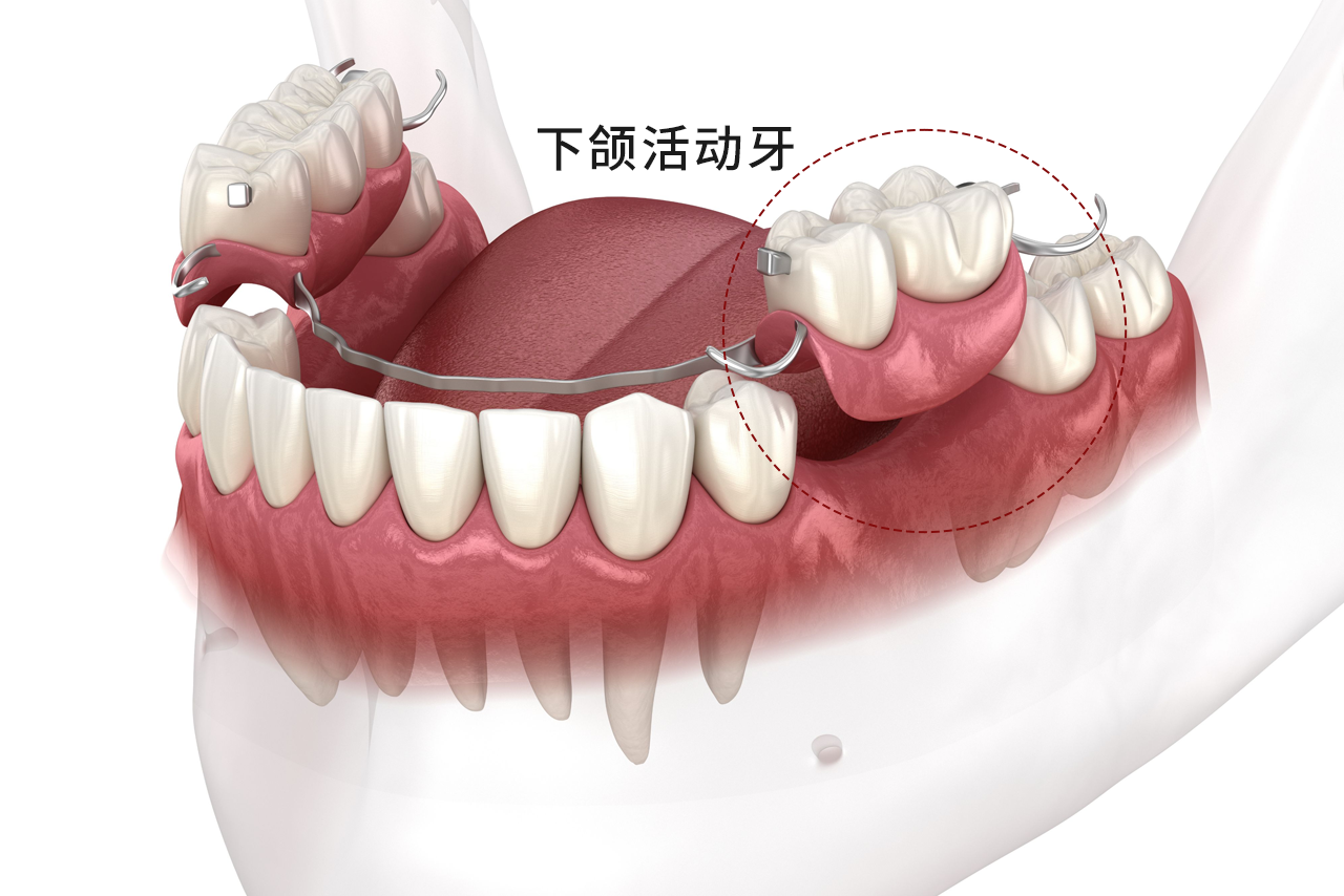 下颌活动牙图片（上下颌牙图片）