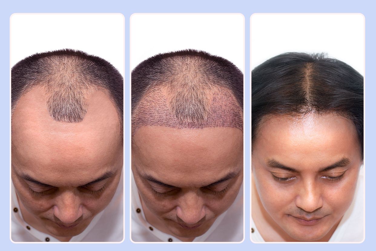植发后头发生长过程图片（植发后头发的生长过程）