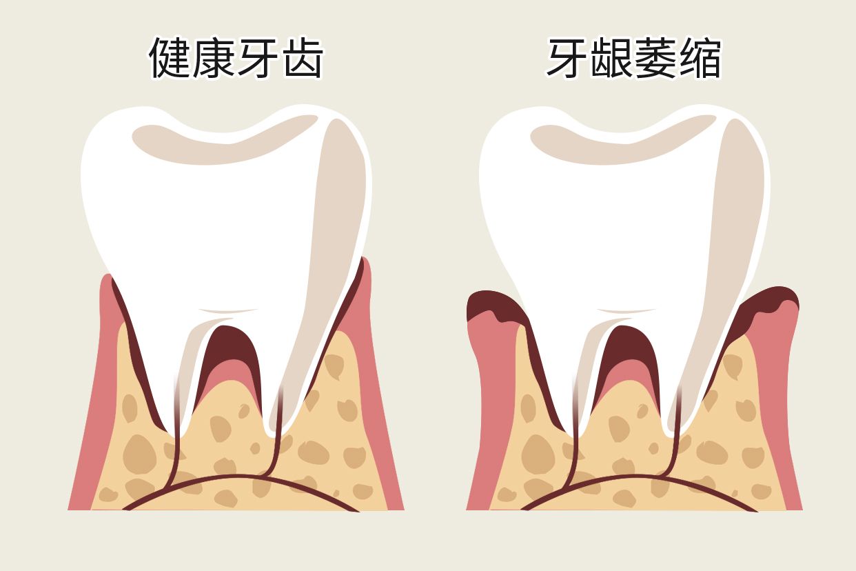 单个牙龈萎缩图片（牙龈轻度萎缩图片）