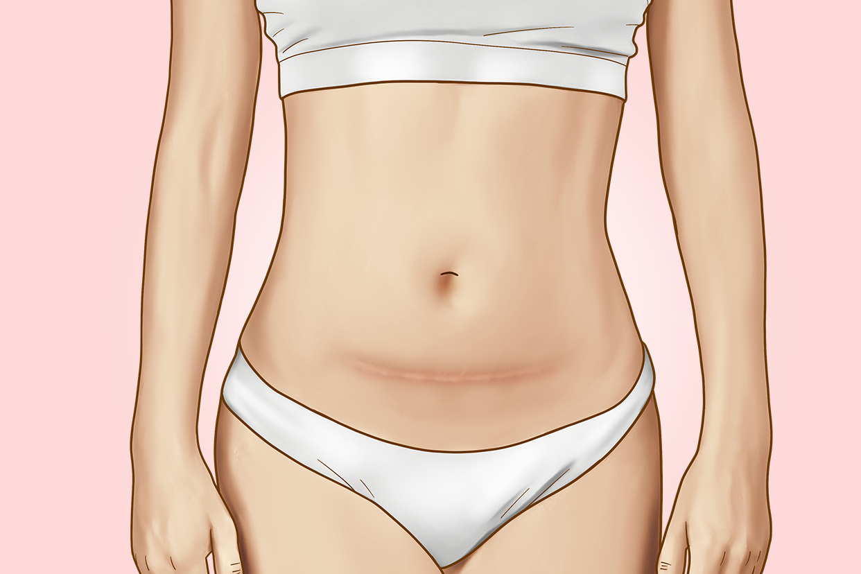 女生肚子上有刀疤是怎么回事图片 女生肚子上有刀疤是怎么回事图片大全