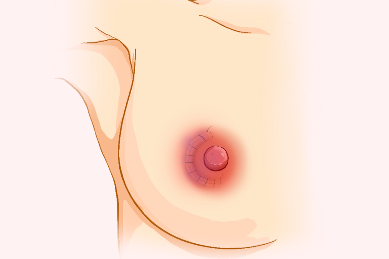 浆乳手术后的疤痕图片（做浆乳手术刀口大概有多长呢）
