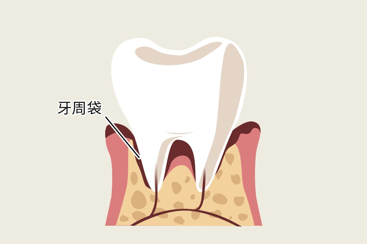 深牙周袋图片（牙周袋深度表）