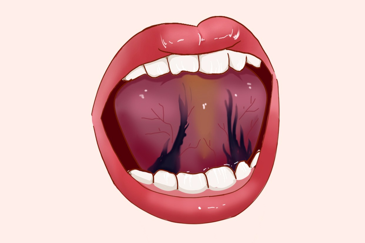 舌根淤堵图片（舌根淤堵图片）