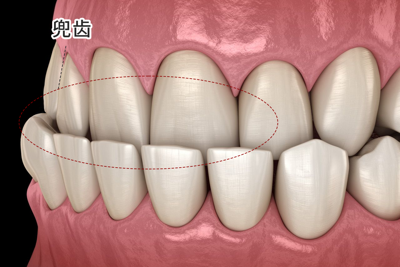 兜齿严重的照片 兜齿怎么回事