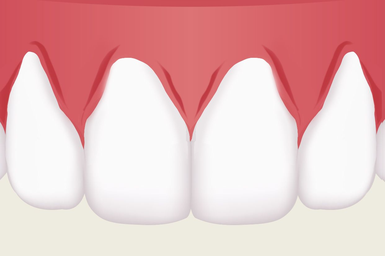 上排侧面牙牙龈萎缩图 下排牙牙龈萎缩图